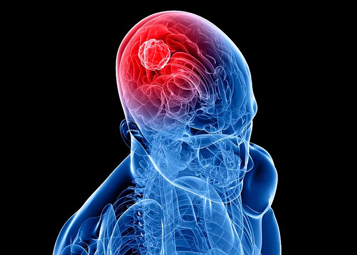 sintomas de cancer en el cerebro