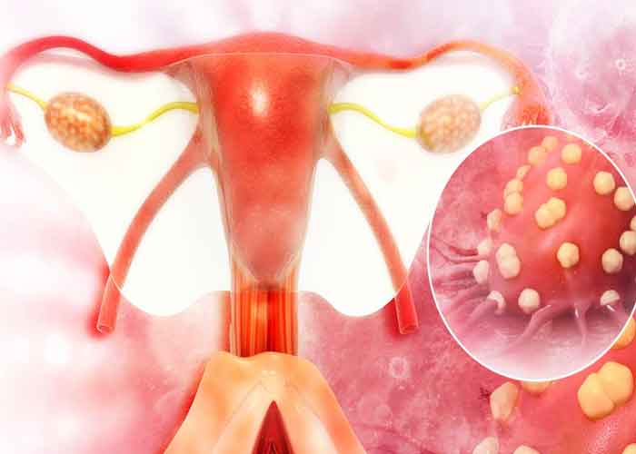 salud, cancer de ovarios, sintomas, causas, enfermedad