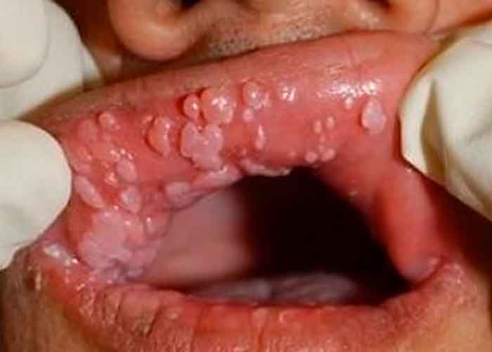salud, vph, boca, sintomas, sexo oral 