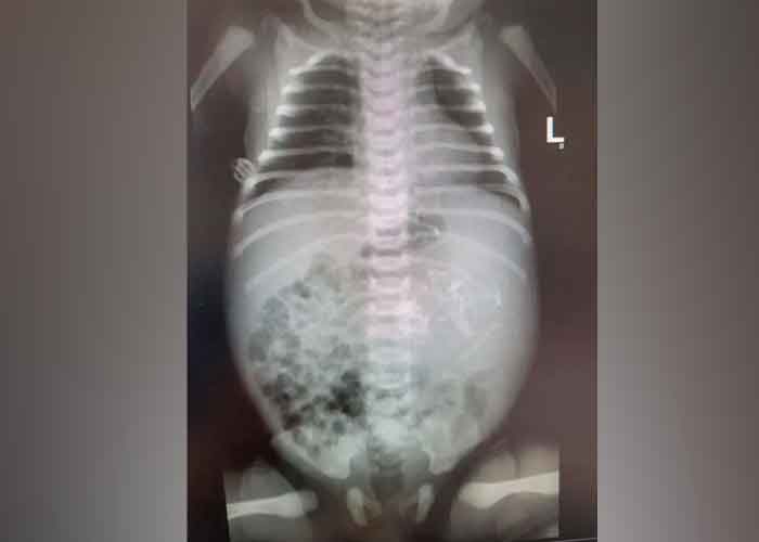 Radiografía del estómago de un  recién nacido 