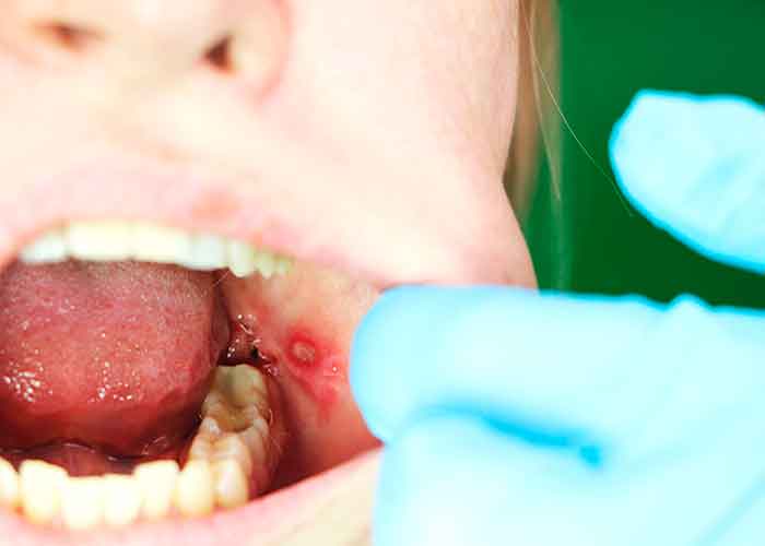 mucositis oral, riesgos, causas, efectos, 