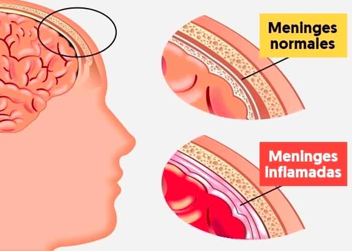 La meningitis es una inflamación peligrosa de las membranas que rodean el cerebro y la médula espinal 