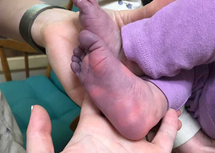 Bebé termina con pies y manos morados tras padecer covid-19