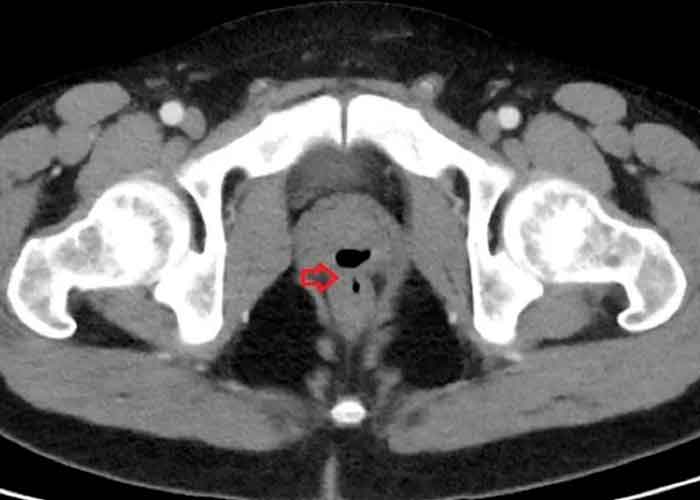 tomografía mostró además una estructura llena de gas dentro de la próstata que se comunica con el recto 