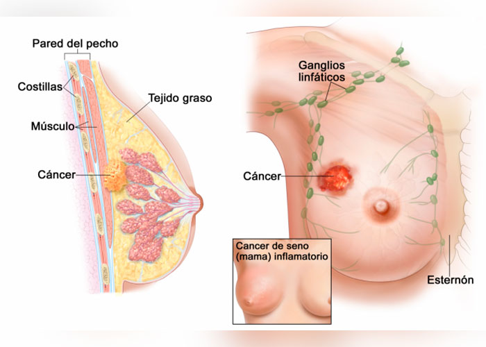 El cáncer de mama la principal causa de mortalidad en las mujeres