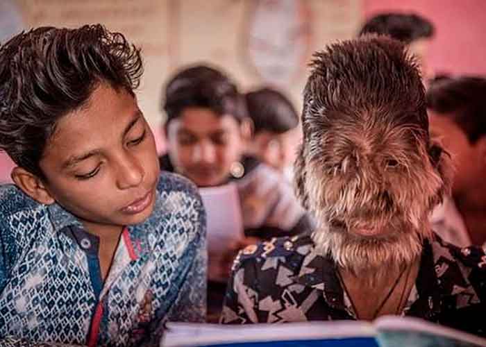 Extraña condición: Adolescente en la India se convirtió en el ‘hombre lobo"