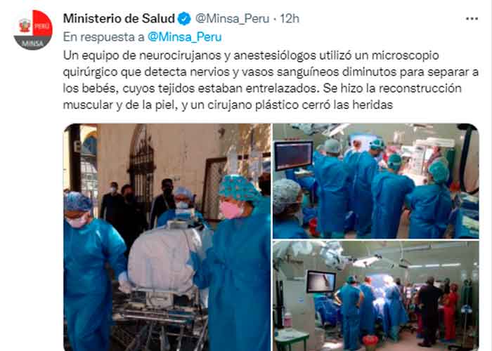 Tras 7 horas de cirugía en Perú separan a siameses unidos por la cadera