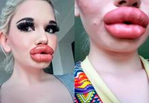 Mujer con los labios más grandes del mundo quiere parecerse a una Bratz