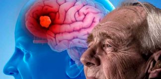 ¡Al fin! Alzheimer ya se puede detectar a tiempo con uso de escáner