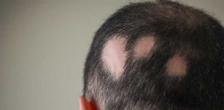 Un nuevo y prometedor medicamento contra la alopecia areata