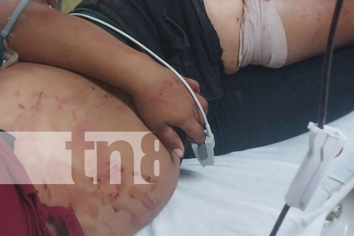 Foto: Entre la vida y la muerte se debate una joven tras ser apuñalada por su ex pareja en Bilwi/TN8