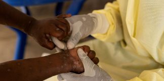 Foto: África declara emergencia sanitaria por brotes de mpox en 13 países