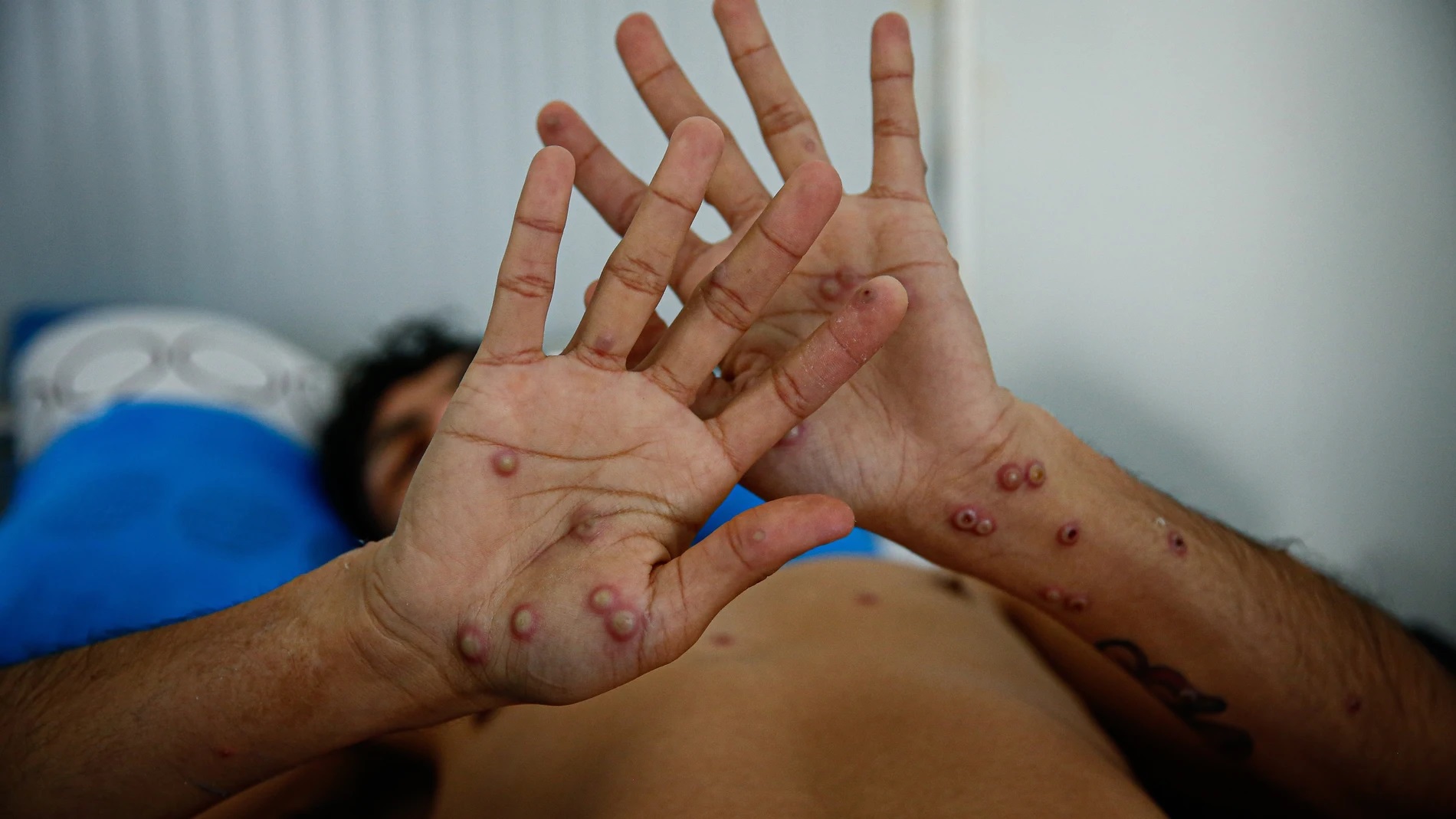 Foto: África declara emergencia sanitaria por brotes de mpox en 13 países