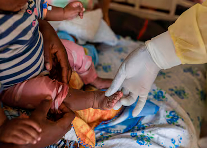 Foto: África ha registrado un total de 50,840 casos de mpox/Cortesía